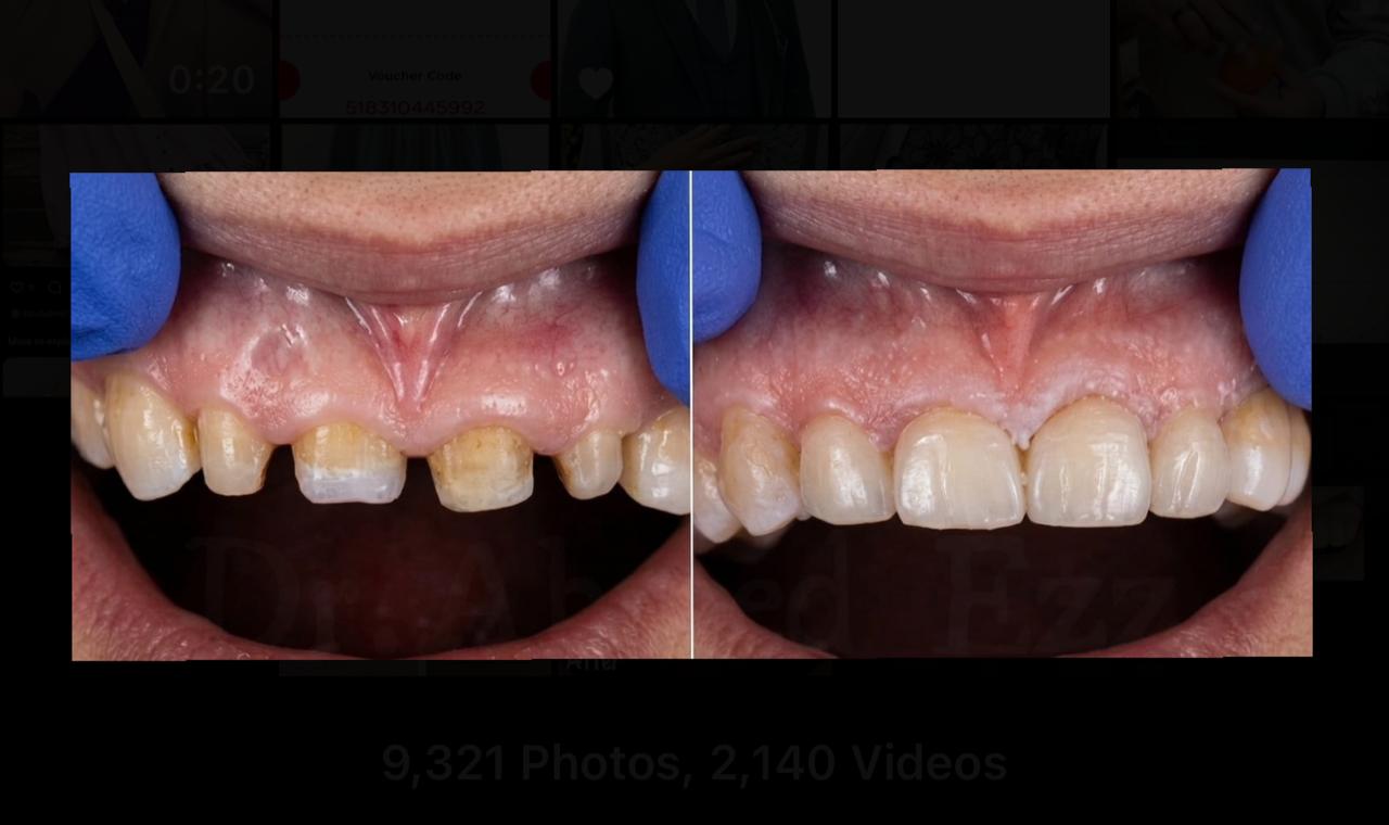 Before Treatment